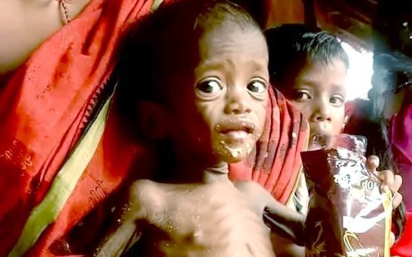 Fight Against Acute Malnutrition Among Children; Special Centres Set Up in Odisha